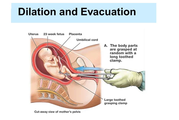 Abortions