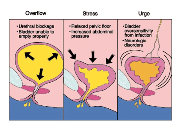 Urinary Complains