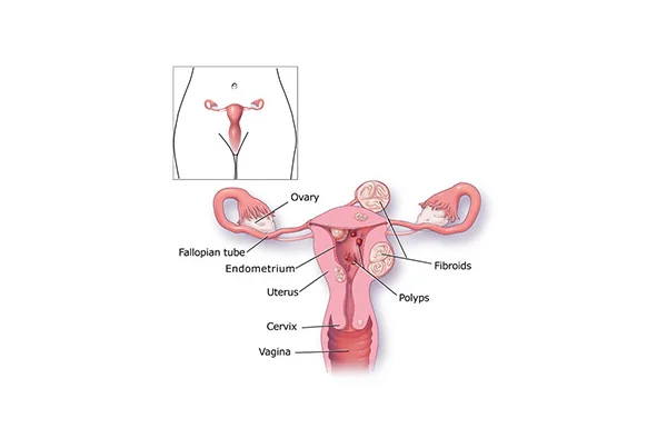 Excessive Flow-Menorrhagia