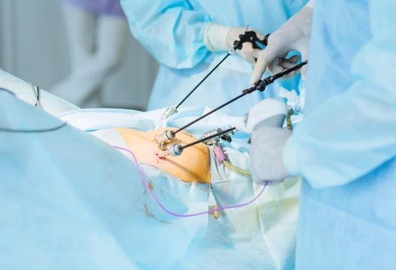 Laparoscopic Operation