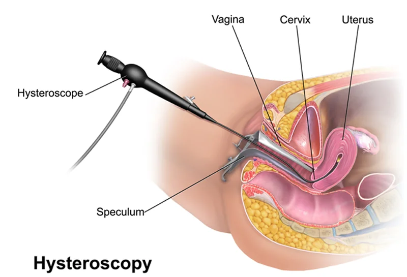 Hysteroscopic Operation