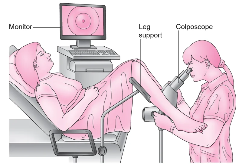 Colposcopy